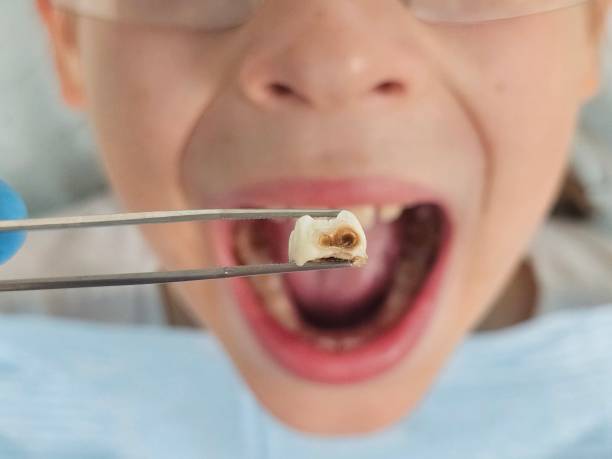 Best Emergency Tooth Extraction in Wind Gap, PA